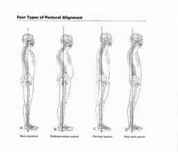 forward head posture causes neck pain