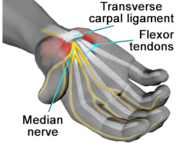 carpal tunnel syndrome treatment in denver co
